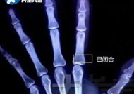 13岁男孩过度进补，一天吃四顿身高定格170