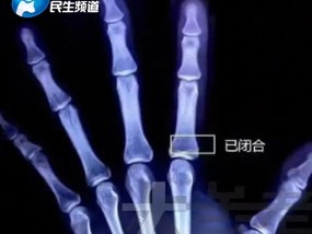 13岁男孩过度进补，一天吃四顿身高定格170