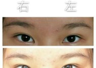 眼镜不对称如何矫正？矫正视频教程在哪里找？