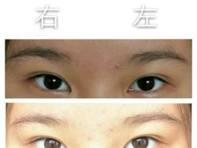 眼镜不对称如何矫正？矫正视频教程在哪里找？
