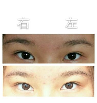 眼镜不对称如何矫正？矫正视频教程在哪里找？  第1张